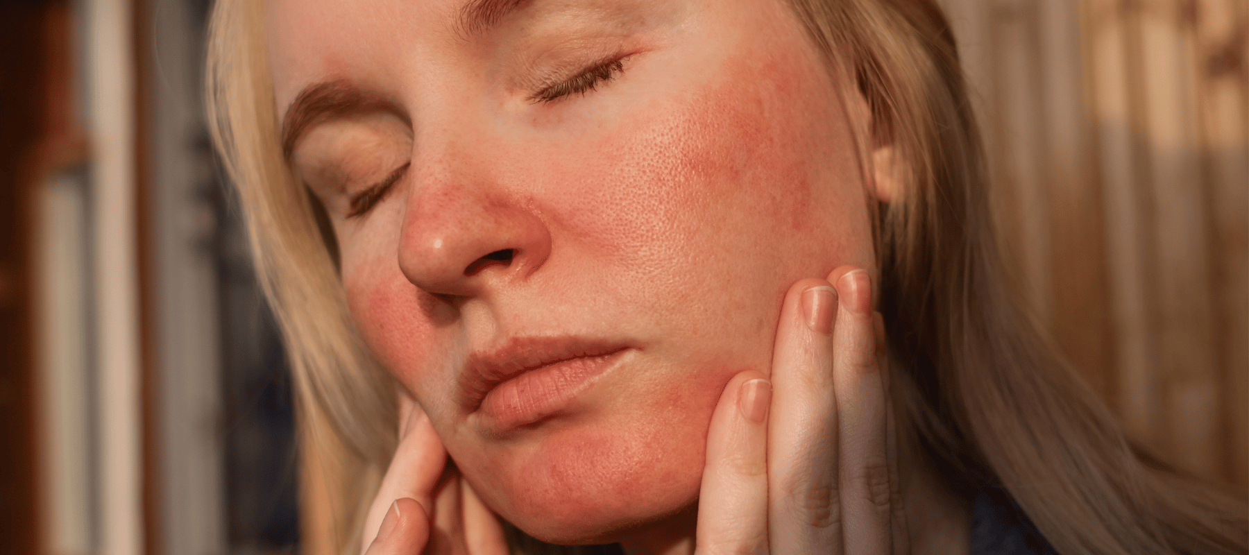 ¿Cómo cuidar una piel con rosácea?