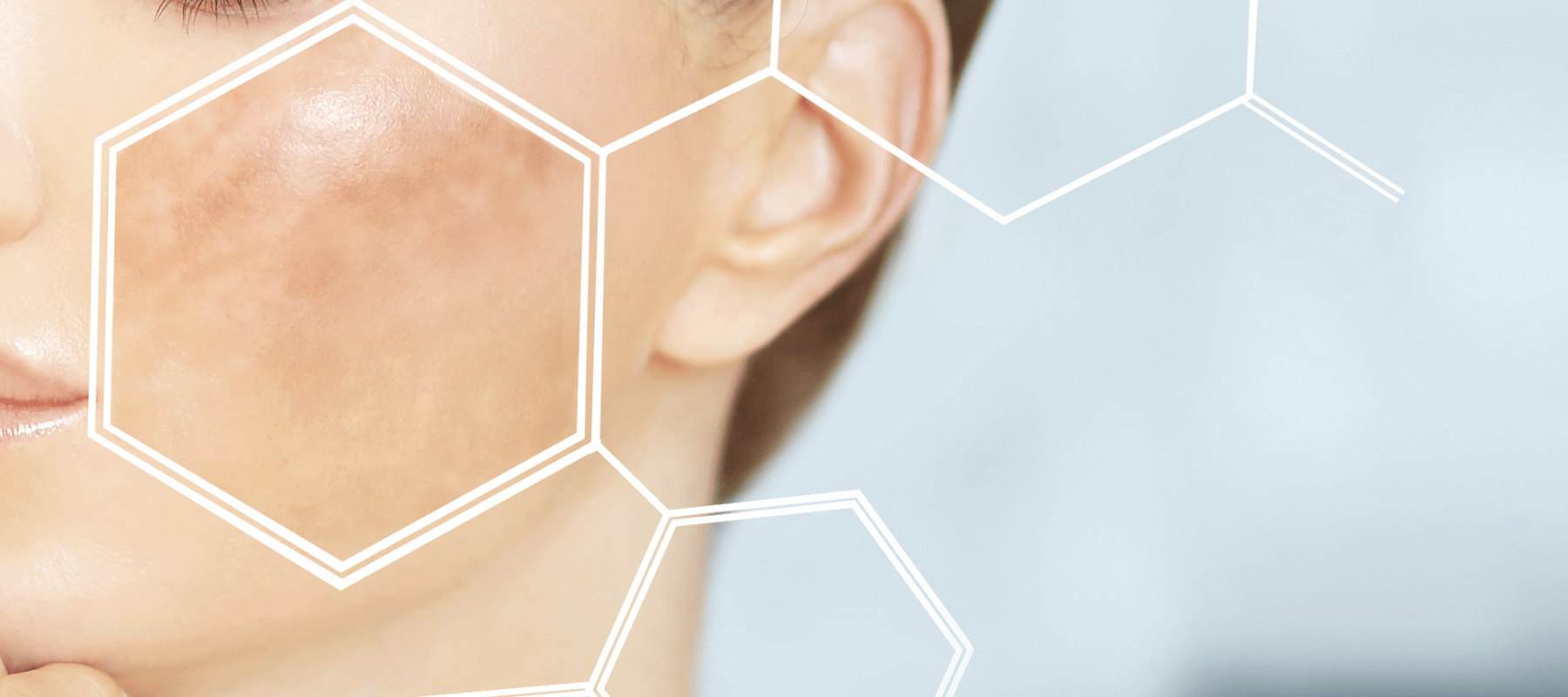 El poder despigmentante del Ácido Tranexámico